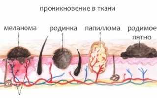 Что будет, если оторвать папиллому