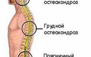 Остеохондроз спины