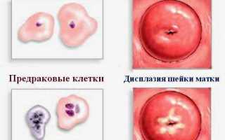 Выраженная пролиферация цилиндрического эпителия в гинекологии