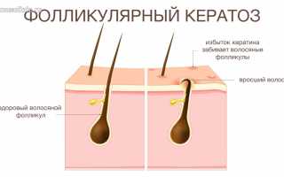 Лечение фолликулярного кератоза кожи