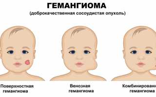 Гемангиома