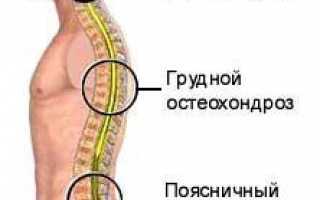 Виды остеохондроза