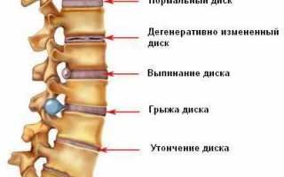 Степени и стадии остеохондроза