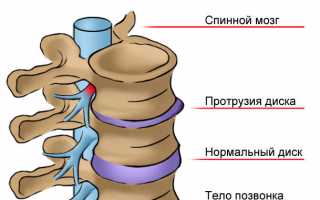 Температура при остеохондрозе