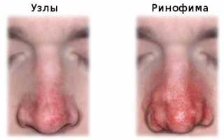 Ринофима носа