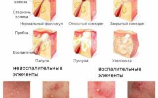 Разновидности прыщей