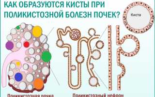 Питание при поликистозе почек