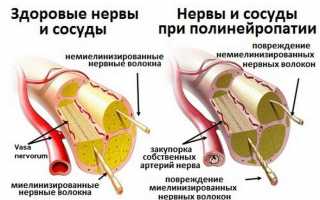 Метаболическая полинейропатия что это такое