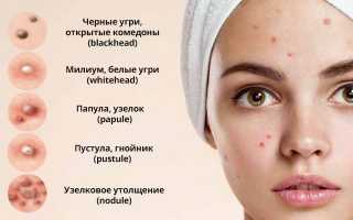 Открытые комедоны