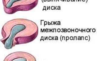 Болезни позвоночника