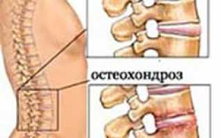 Капельницы при остеохондрозе