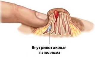 Кровянистые выделения из молочных желез