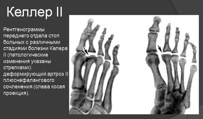 рентгенограмма стопы при болезни Келлера II