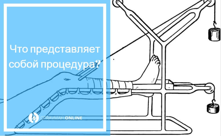 скелетное вытяжение при переломе бедра для чего