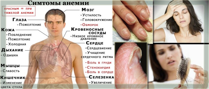 Признаки анемии