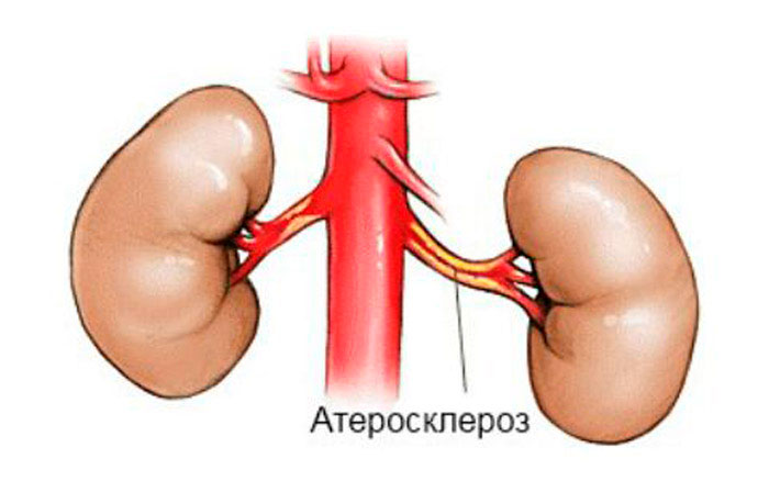 атеросклероз почечных артерий