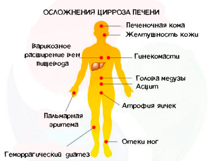осложнения цирроза