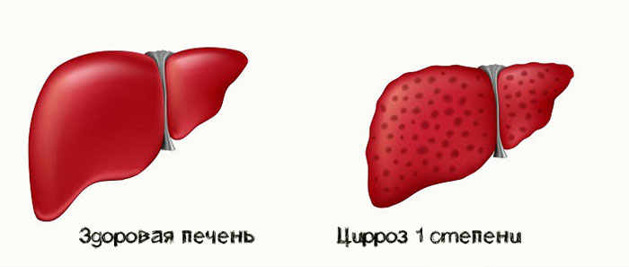 здоровая печень и цирроз