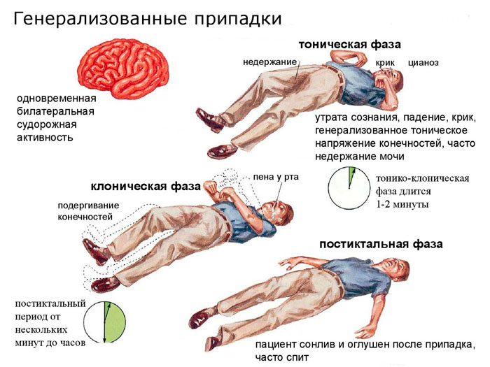 генерализованный припадок