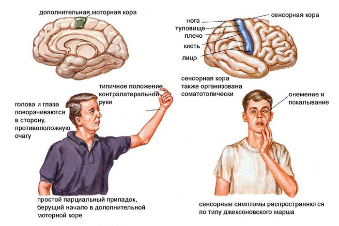 моторный припадок