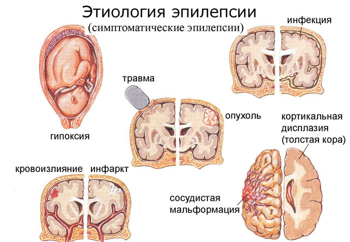 причины эпилепсии
