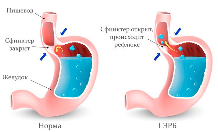 Гастроэзофагеальный рефлюкс
