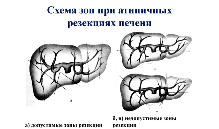 резекция печени