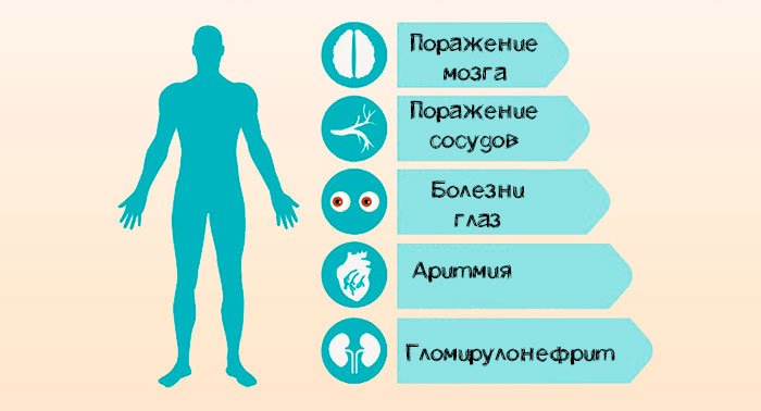 осложнения гипертонии 3 степени