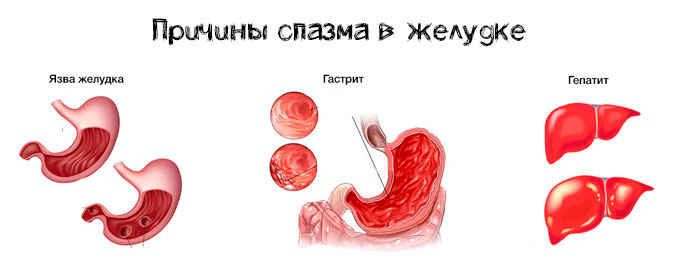 причины спазма в желудке