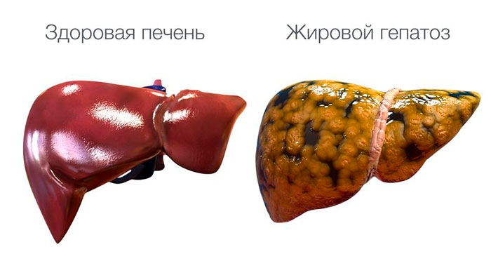здоровая печень и гепатоз