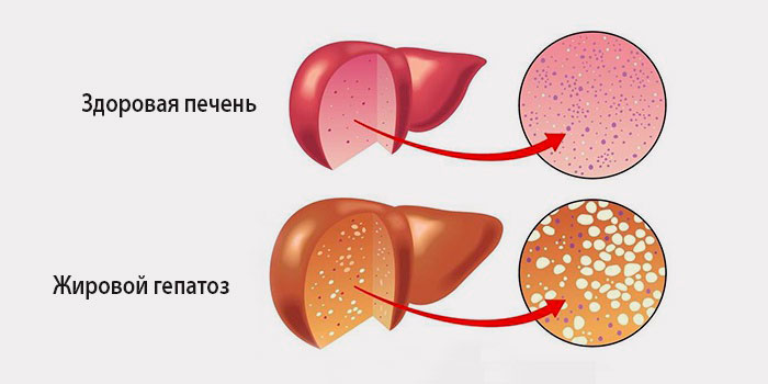 клетки печени при гепатозе