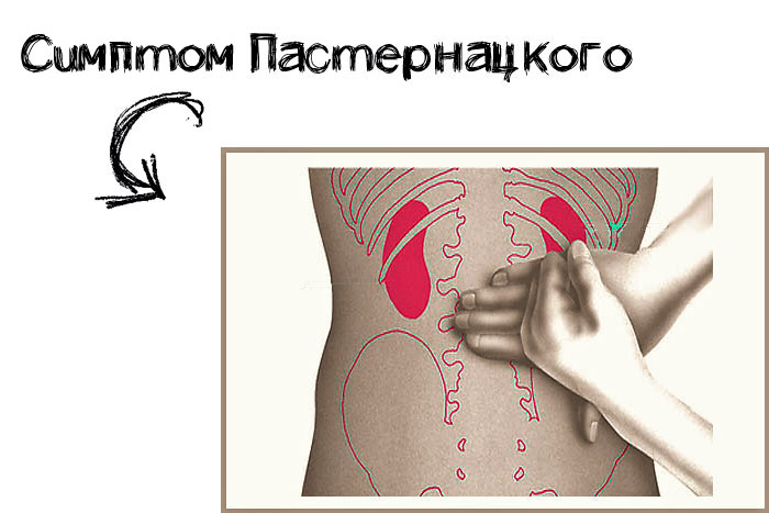 симптом пастернацкого
