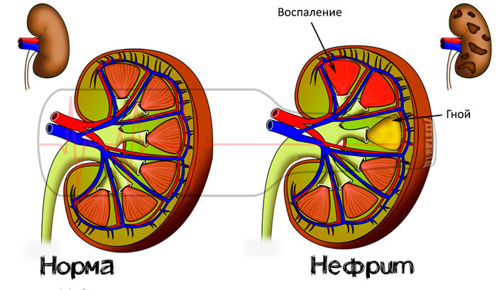 нефрит