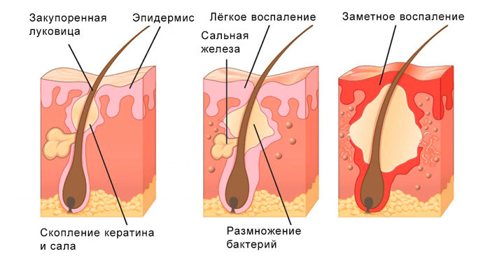 фолликулит