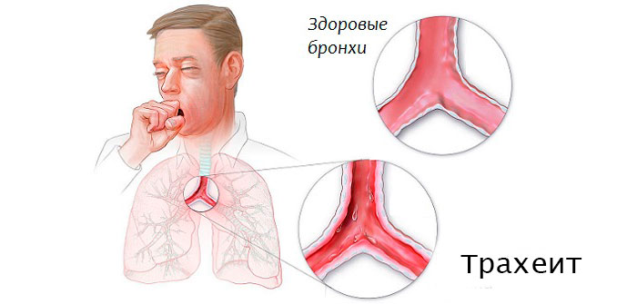 трахеит
