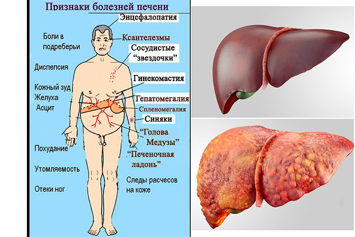 признаки заболевания печени