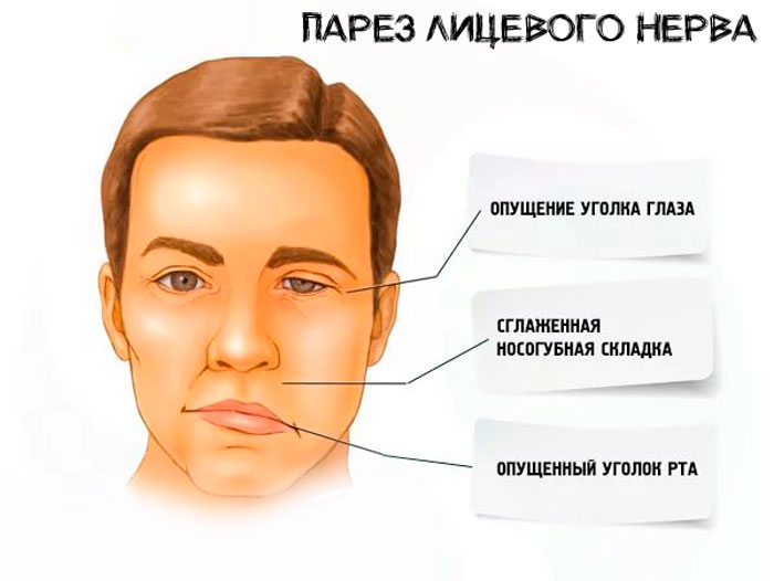 парез лицевого нерва