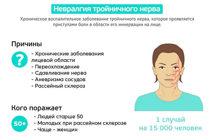 невралгия тройничного нерва