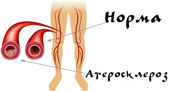норма и атеросклероз