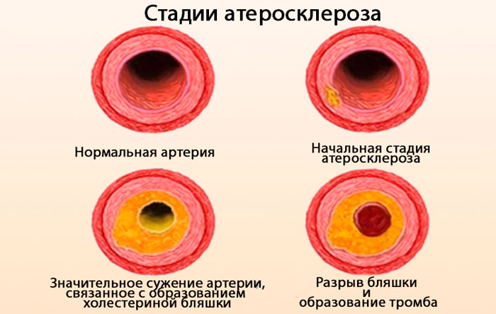 стадии атеросклероза