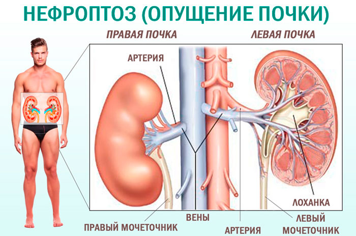 нефроптоз