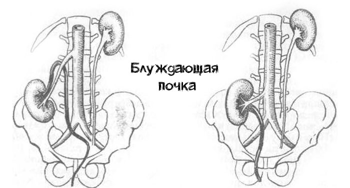 блуждающая почка