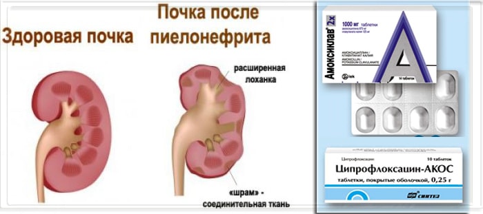 Лекарства от пиелонефрита