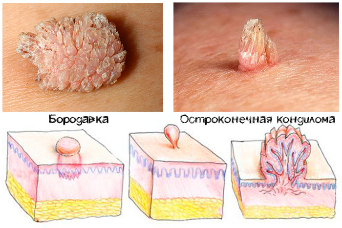 бородавка и кондилома