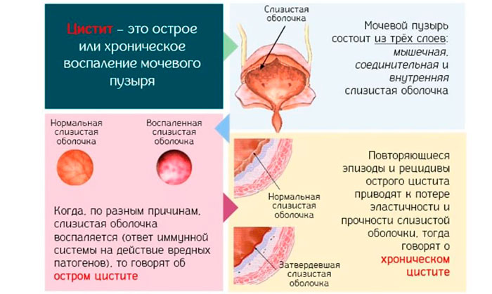 цистит