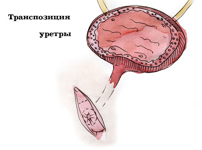 транспозиция уретры