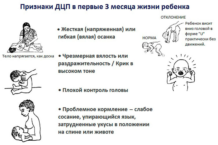ДЦП в 3 месяца