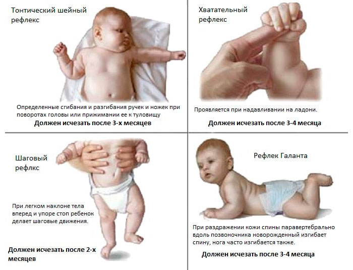 признаки ДЦП