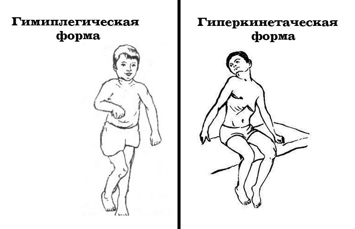гиперкинетическая и гимипленическая формы