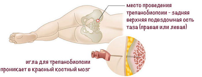 трепанобиопсия